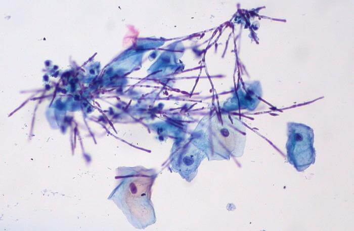 The most common organism implicated in fungal infections is Candida. Photo: Ed Uthman